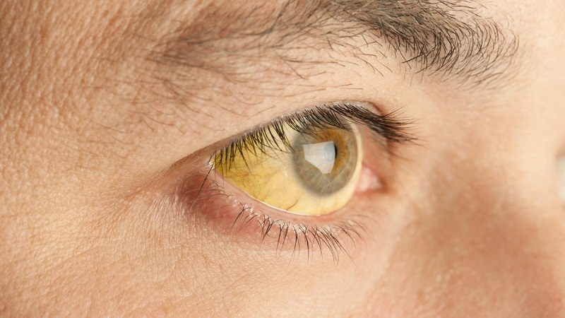 8 сигналов, при помощи которых глаза предупреждают о проблемах со здоровьем