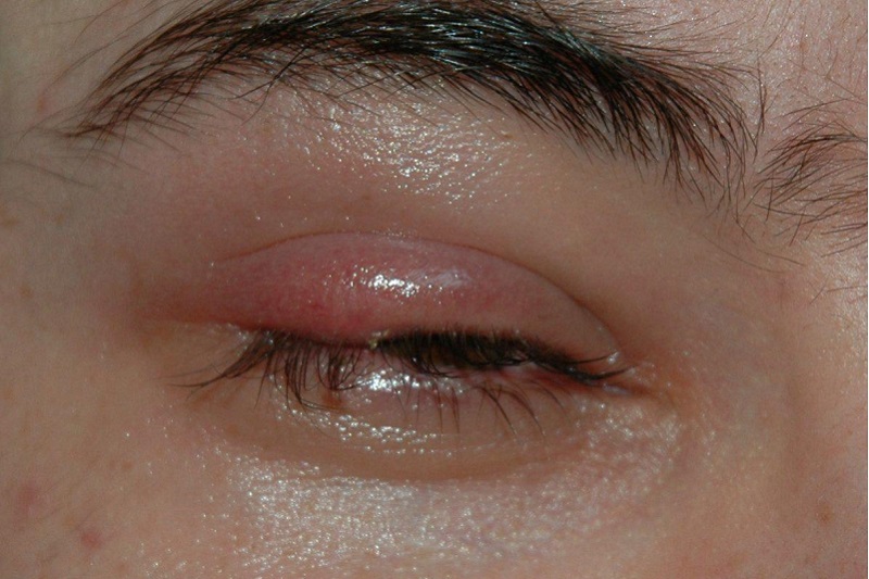 8 сигналов, при помощи которых глаза предупреждают о проблемах со здоровьем