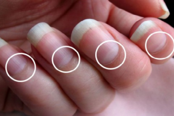 Есть ли у вас так называемый «полумесяц» на ногтях? узнайте, о это свидетельствует